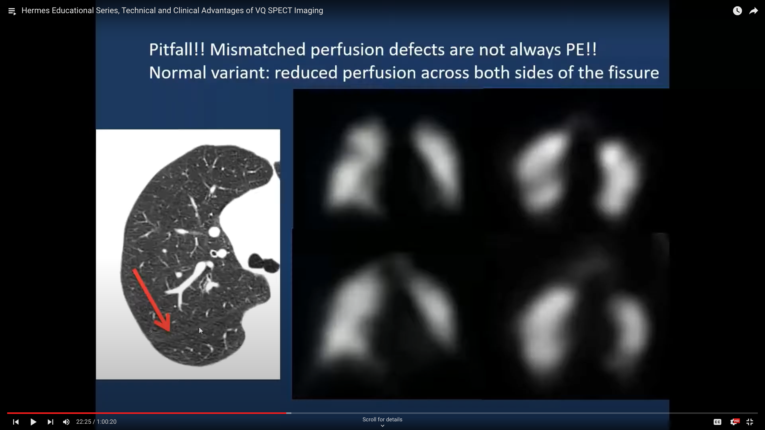 Technical and Clinical Advantages of VQ SPECT Imaging Hermes Medical