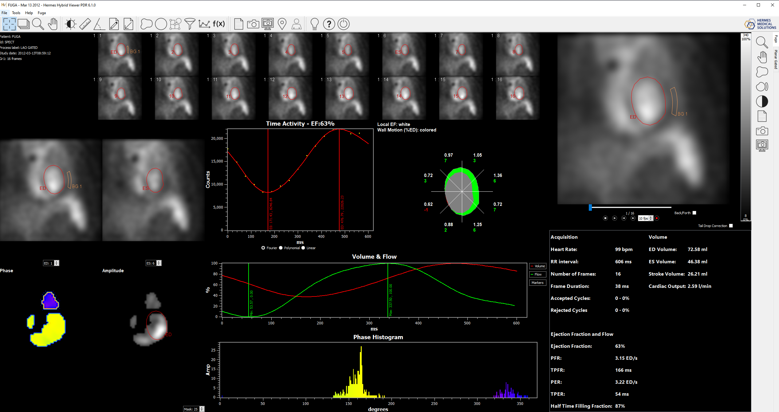 Cardiology image in nuclear medicine - Myocardium Gated Analysis (MUGA/FUGA)