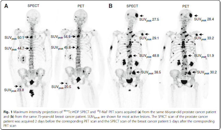 Skeleton scans for Maximum intensity projections of 99mTc-HDP SPECT and 18F-NAF PET scans acquired (a) from a 66-year-old prostate cancer patient, and (b) from a 75-year-old breast cancer patient