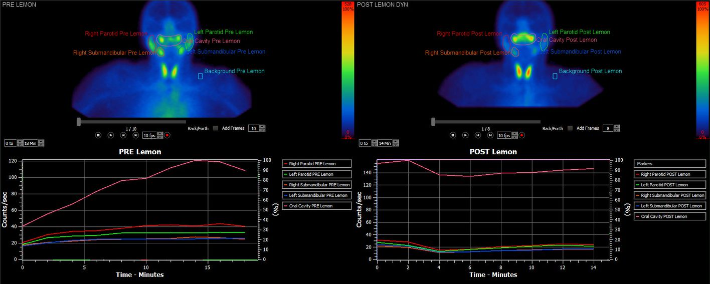 Salivary gland analysis indications with dual phase acquisition