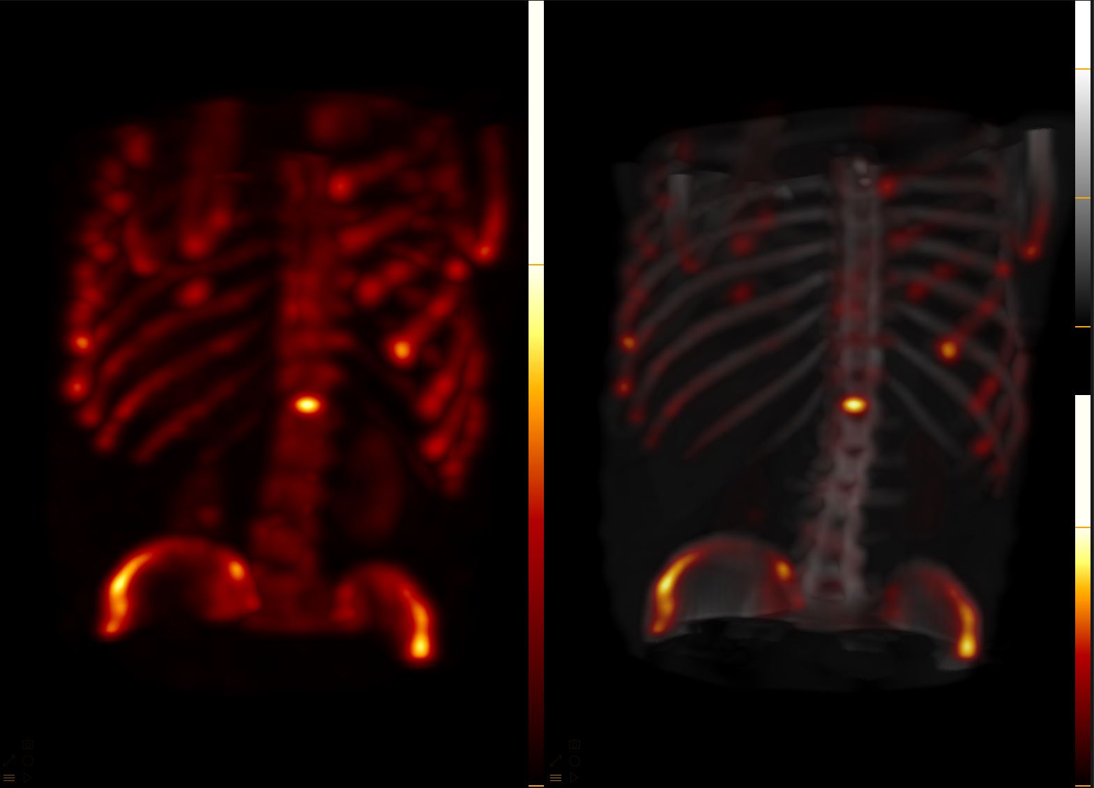 99mTc-MDP SPECT/CT Bone Rendering