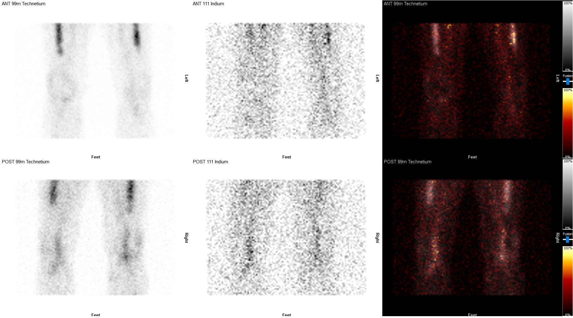 99mTc – In111 Dual Isotope Planar Image Fusion for Osteology in Molecular Imaging