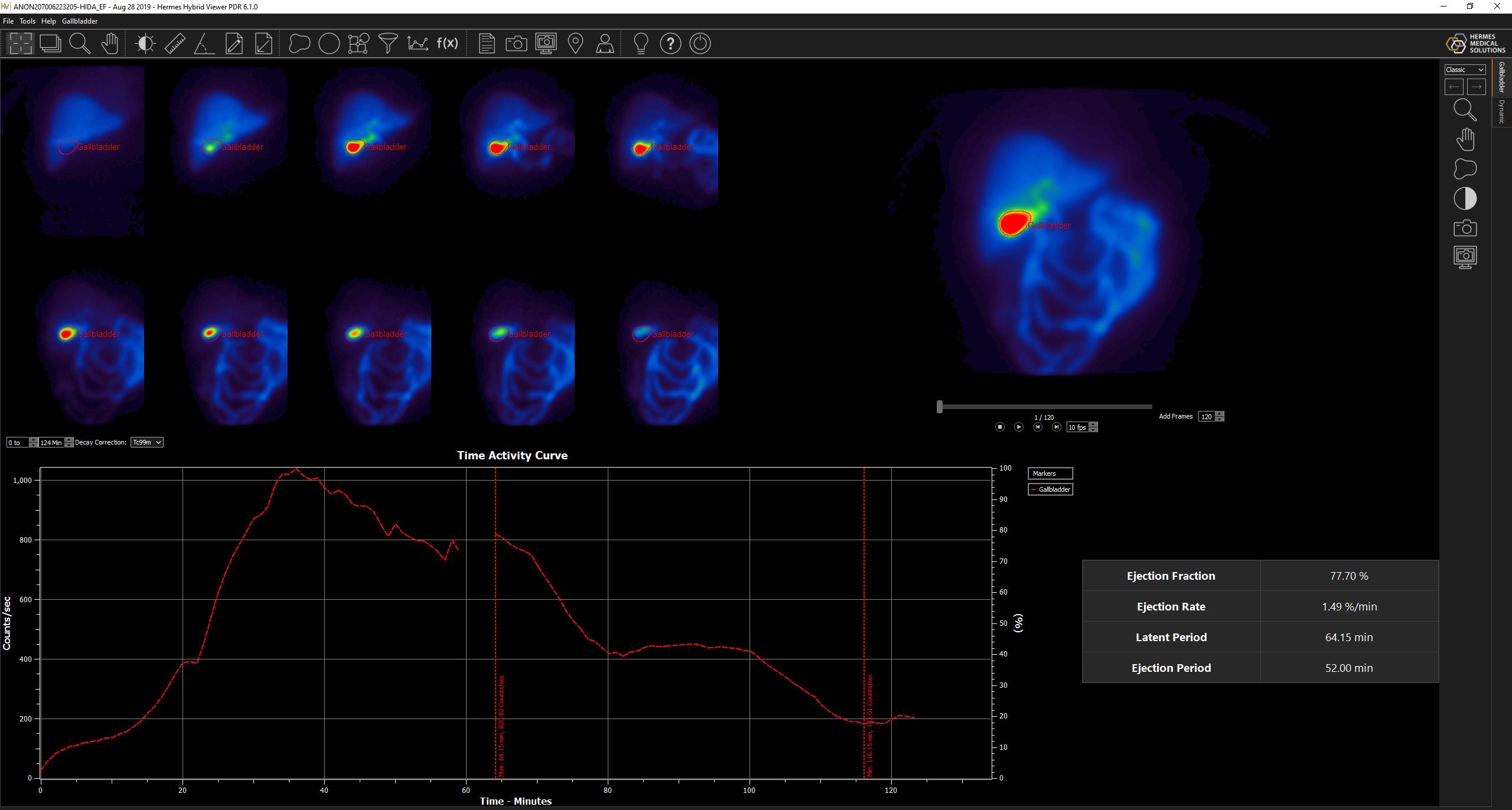 Gallbladder ejection fraction analysis pre and post fatty meal