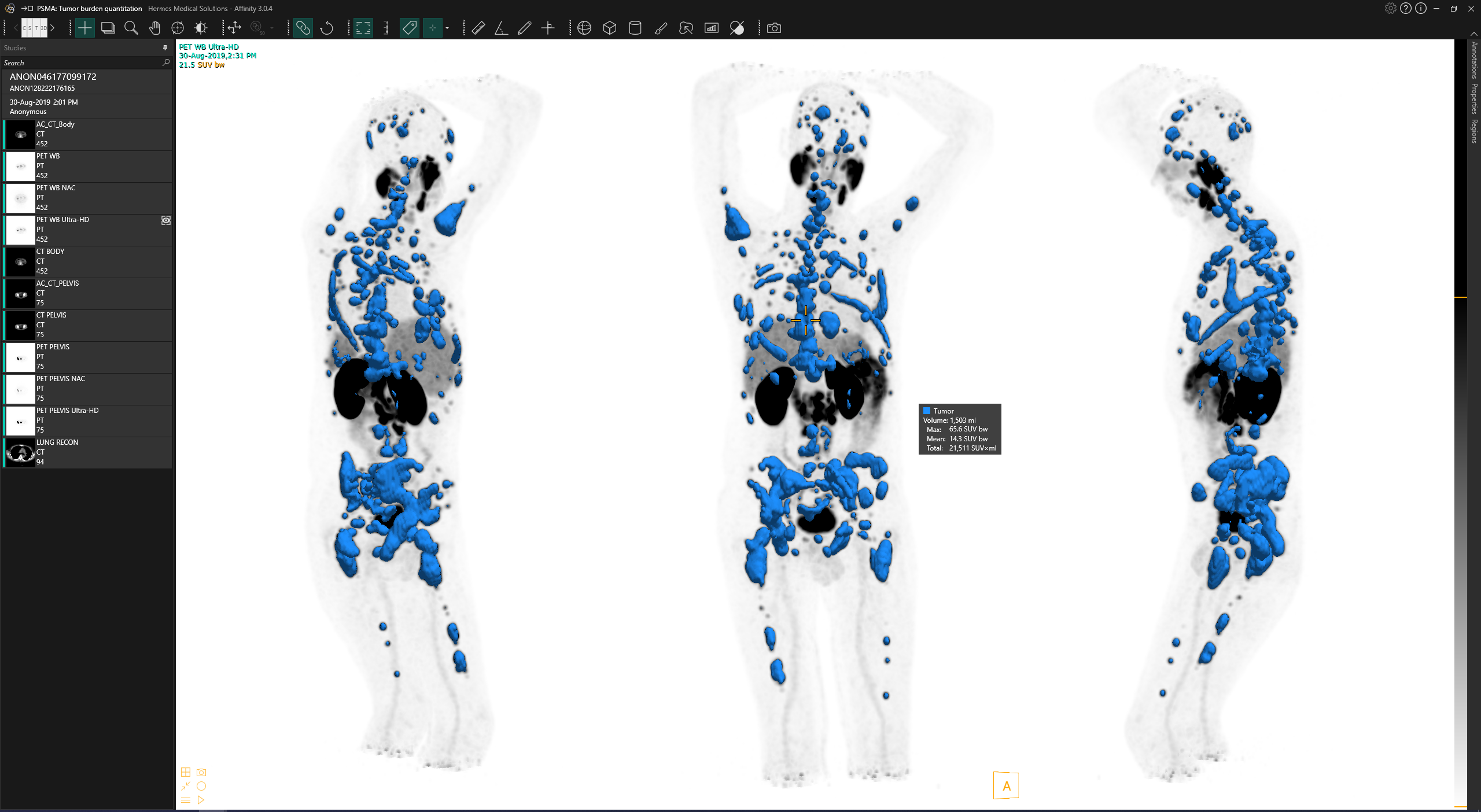 Ga-68 PSMA total tumor burden quantitation with label