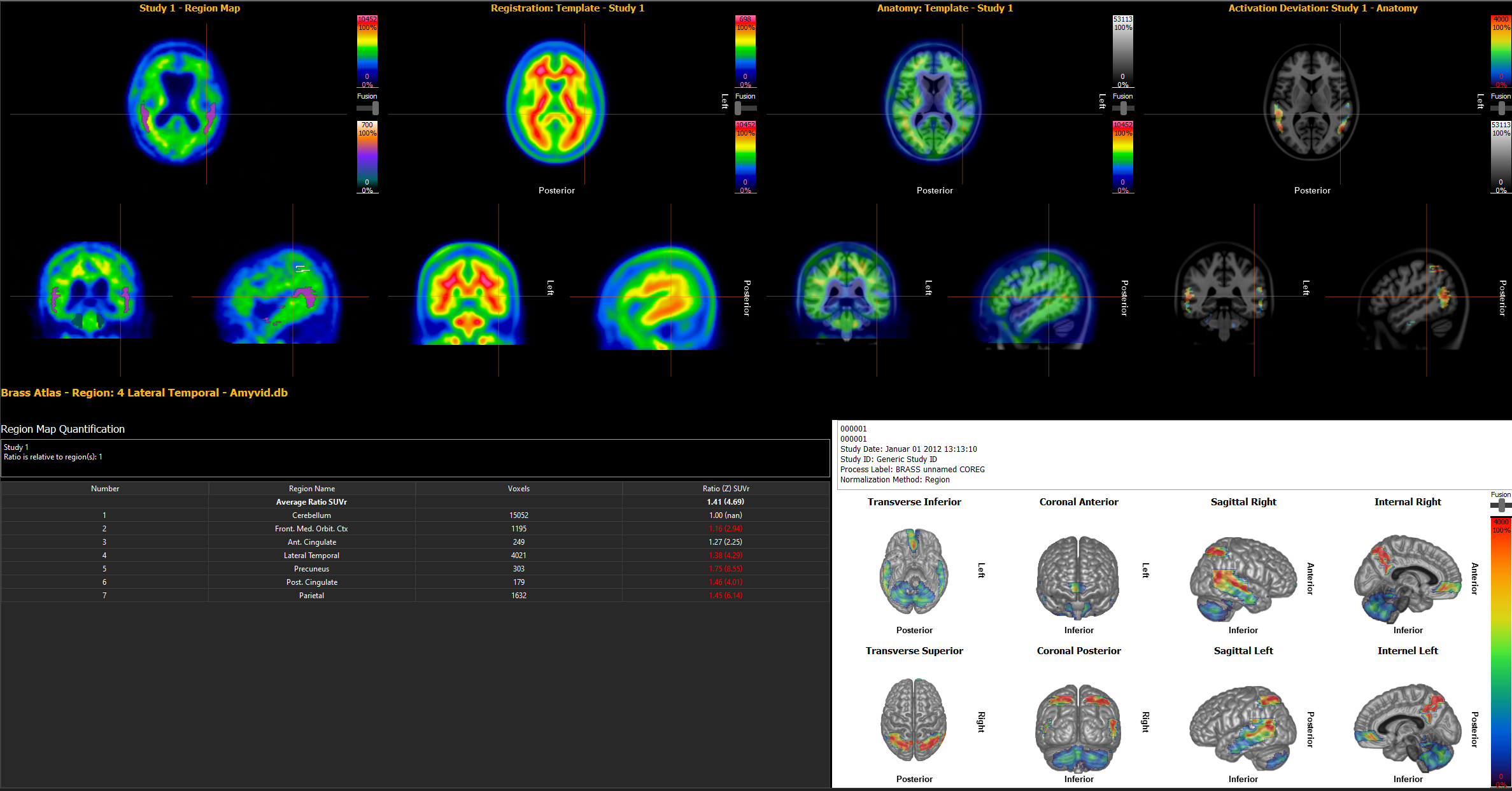 Hermia Neurology (BRASS) featuring a PET Amyloid case with Amyvid