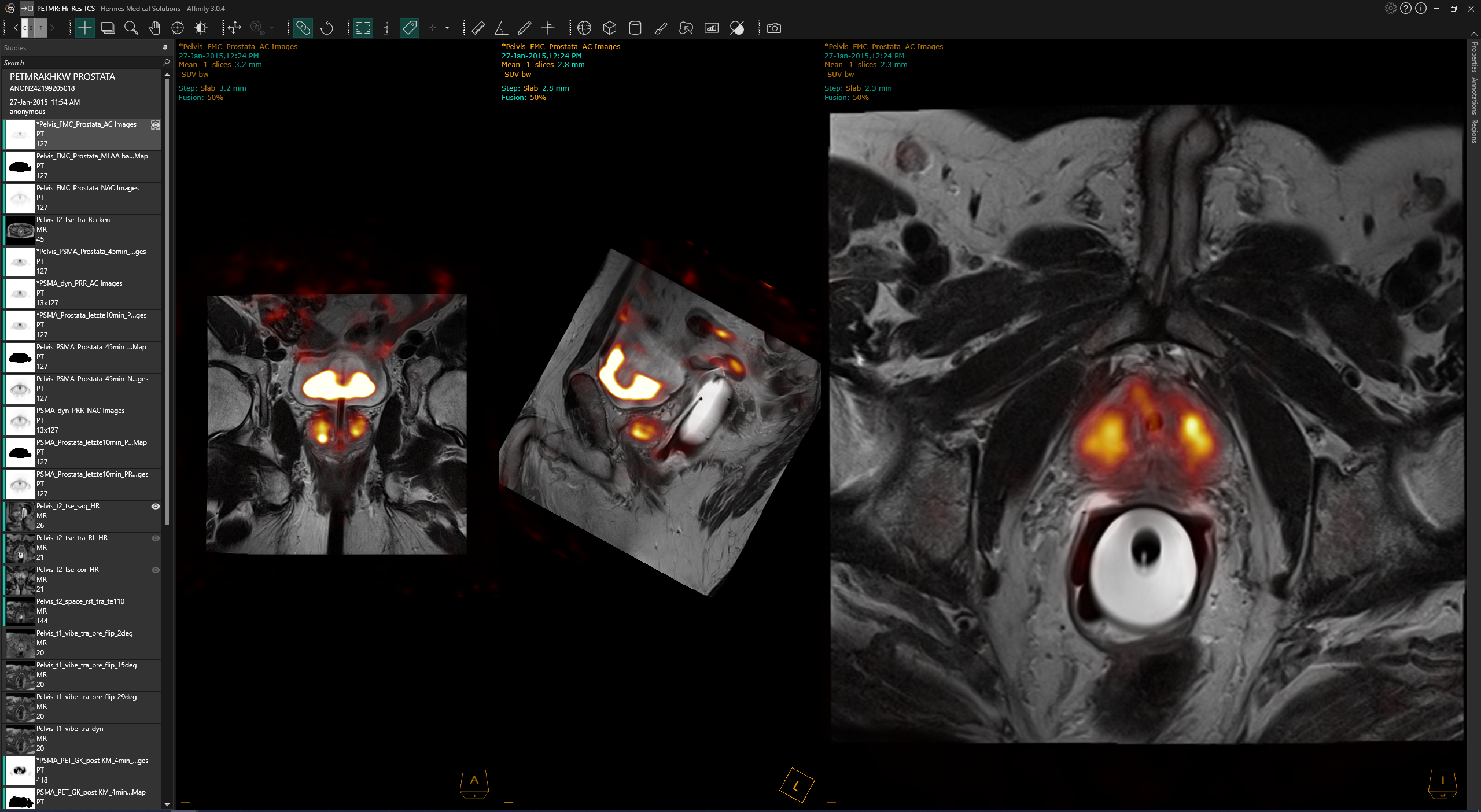 Prostate cancer case viewed in molecular imaging software