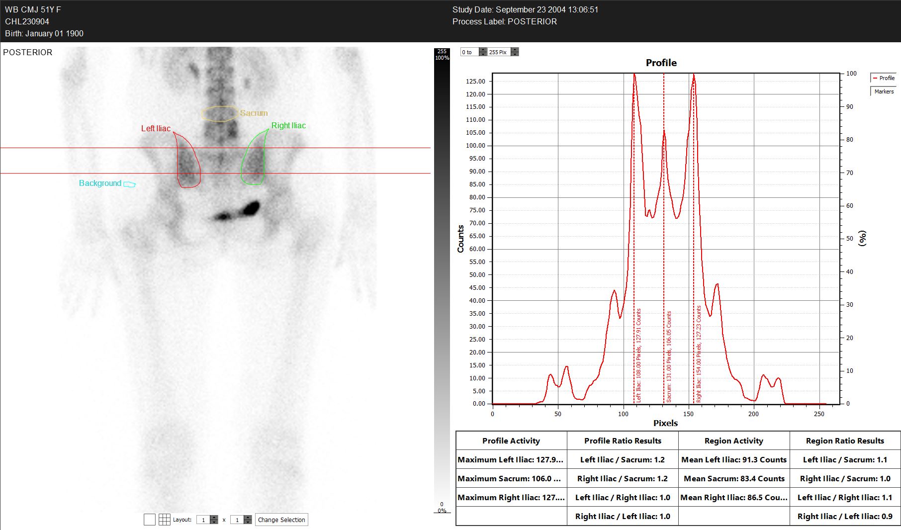 HERMIA Sacro-Iliac Joint CE Marked Application used in Osteology