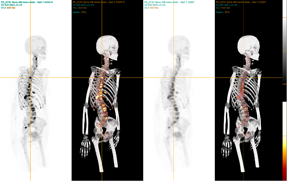 Four whole body SPECT images: 99mTc-HDP SUV-SPECT OSEM vs. AMAP-R Advanced Quantitative Reconstruction