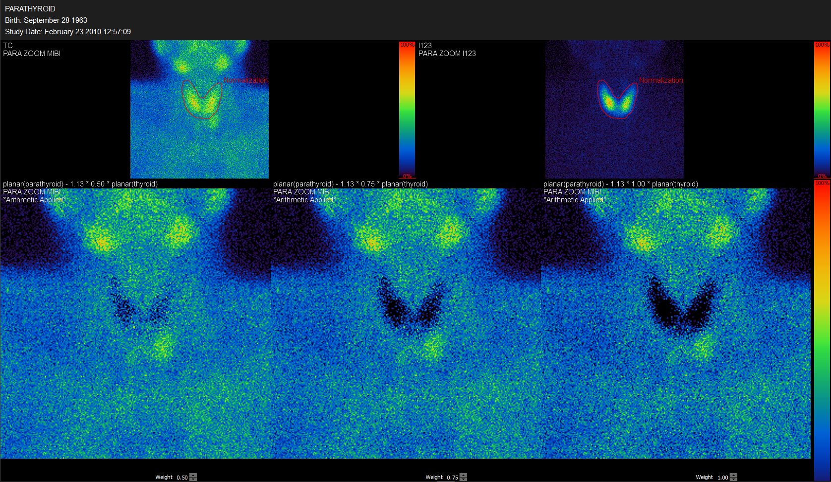 Subtraction techniques facilitate efficient localization of parathyroid pathology on planar, dynamic or SPECT +/- CT imaging.