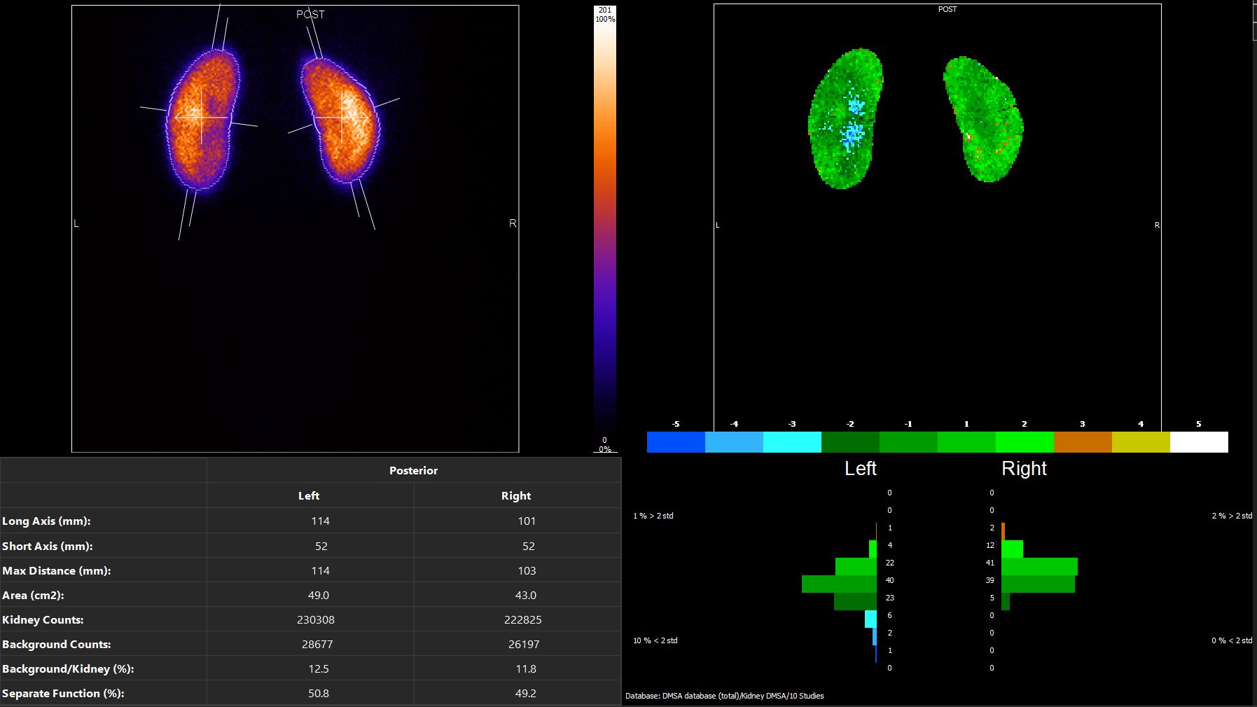 DMSA Analysis with long-short axis determination and normal database comparison