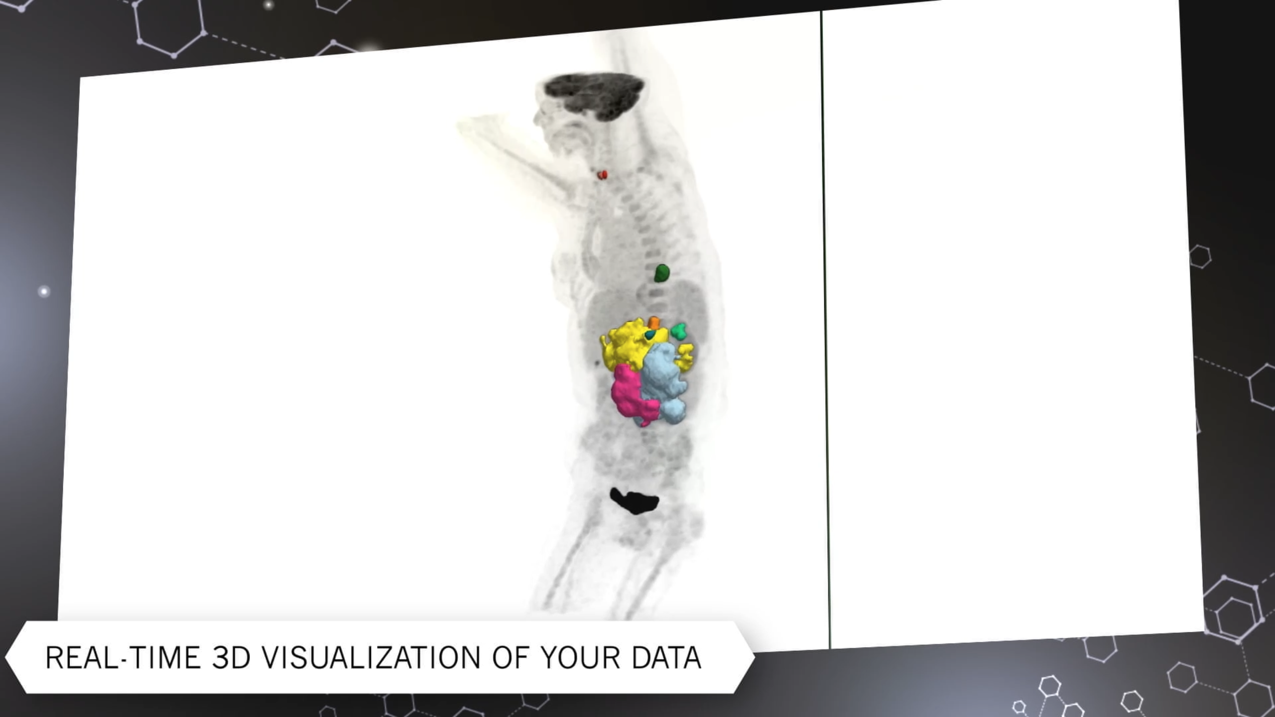 Hermia | PET/CT, SPECT/CT, and PET/MR | Hermes Medical Solutions